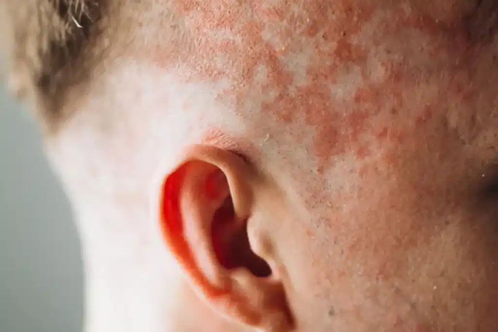 Come si diagnostica la psoriasi