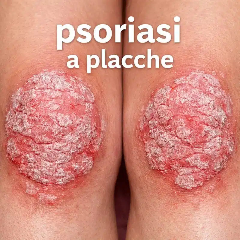 Psoriasi a placche su ginocchia con squame biancastre e arrossamento