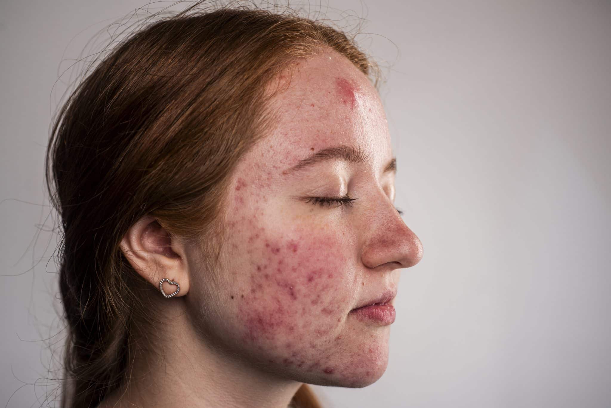 ragazza con acne molto severa sul viso 