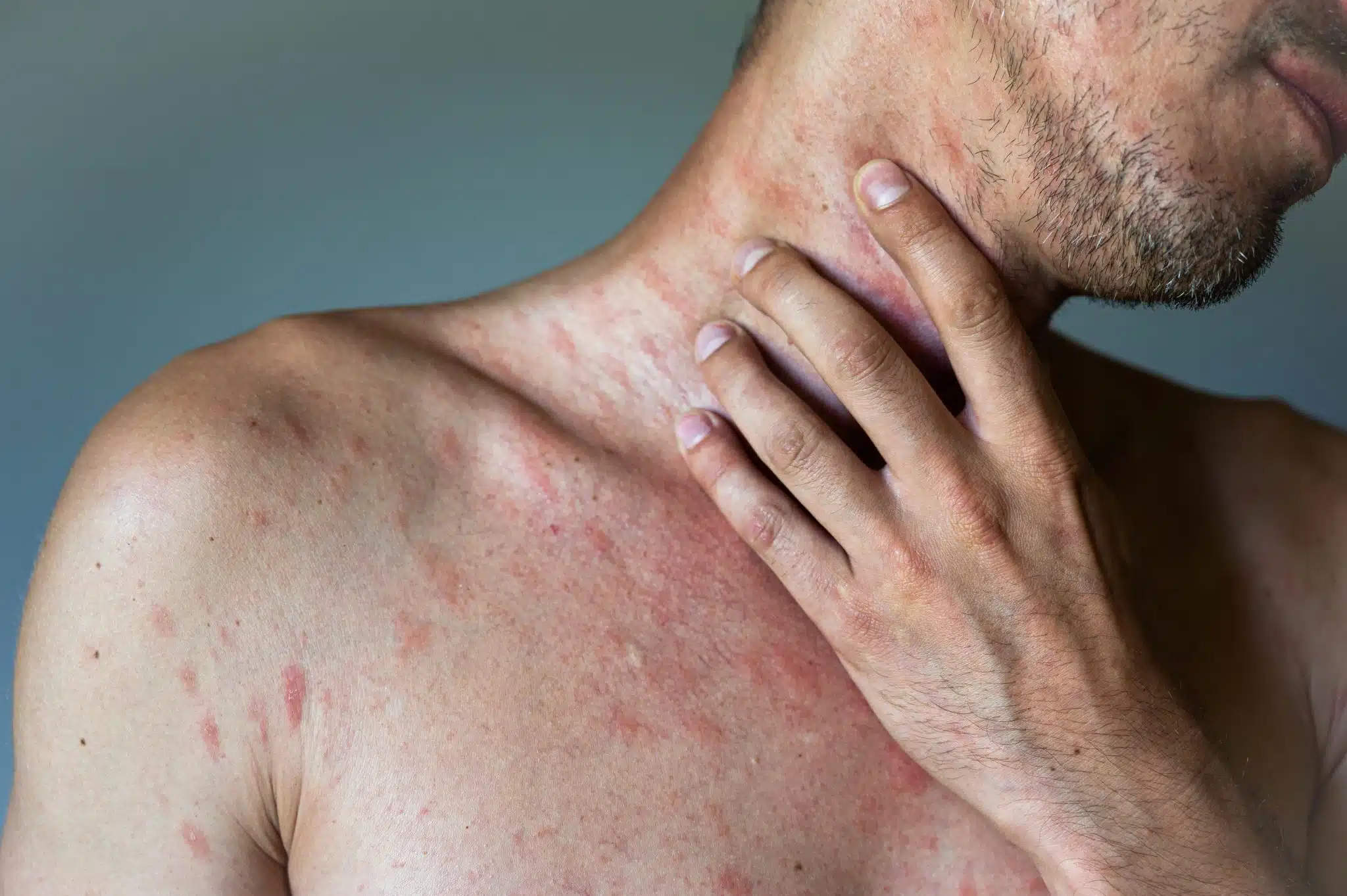 uomo con dermatite atopica su torso, collo e spalle caratterizzata da macchie rosse e pruriginose
