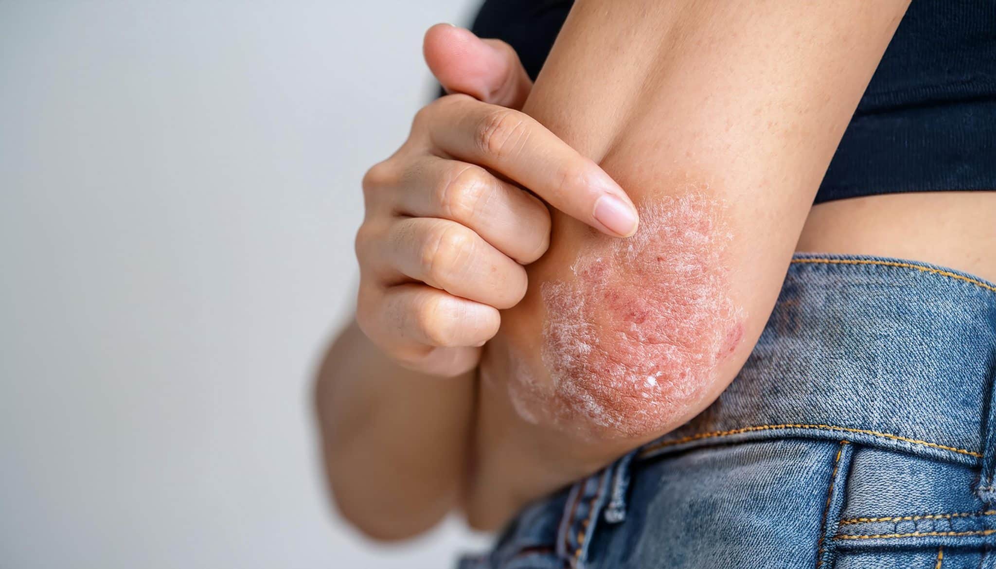 Donna con psoriasi molto acuta sui gomiti 