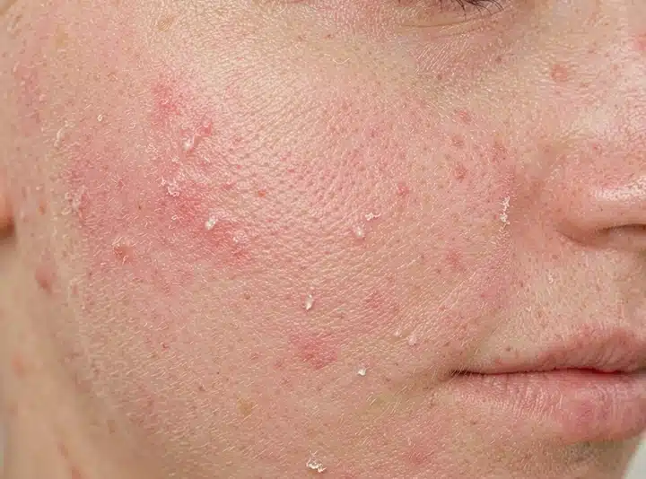 Primo piano su volto con pelle molto secca e screpolata