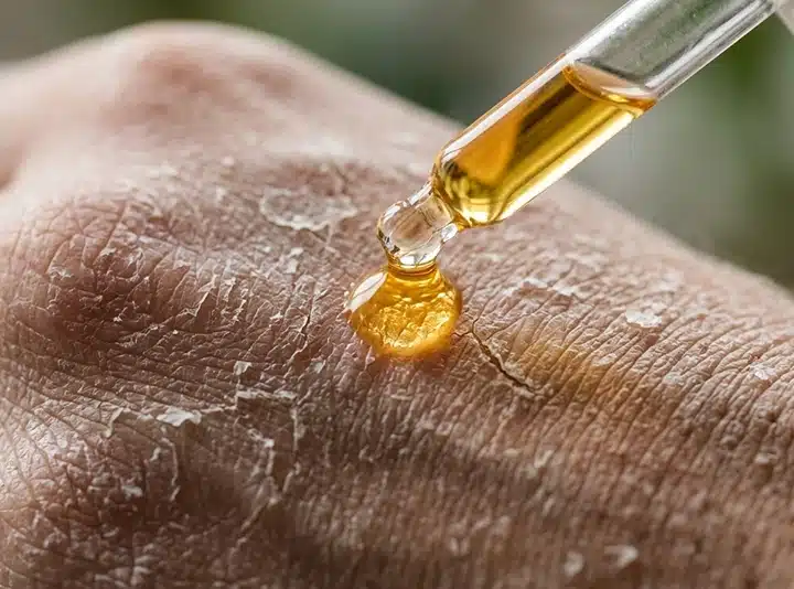 primo piano su una mano dalla pelle molto secca e screpolata sulla quale viene applicato un olio di babassu per idratazione profonda