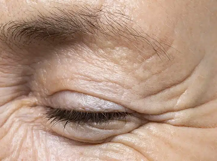primo piano su una porzione del volto segnata da rughe e zampe di gallina sul contorno occhi